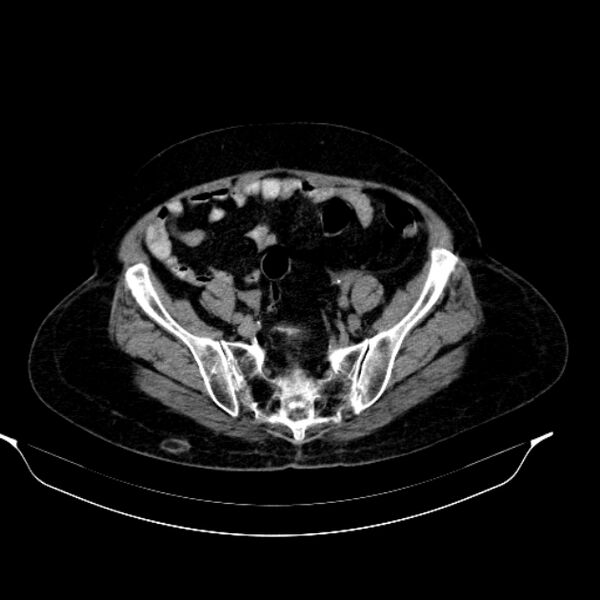 File:Calcified hydatid cyst (Radiopaedia 62000-70085 Axial non-contrast 85).jpg