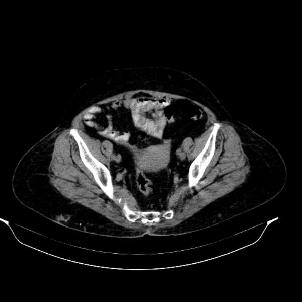 File:Calcified hydatid cyst (Radiopaedia 62000-70085 Axial non-contrast 91).jpg