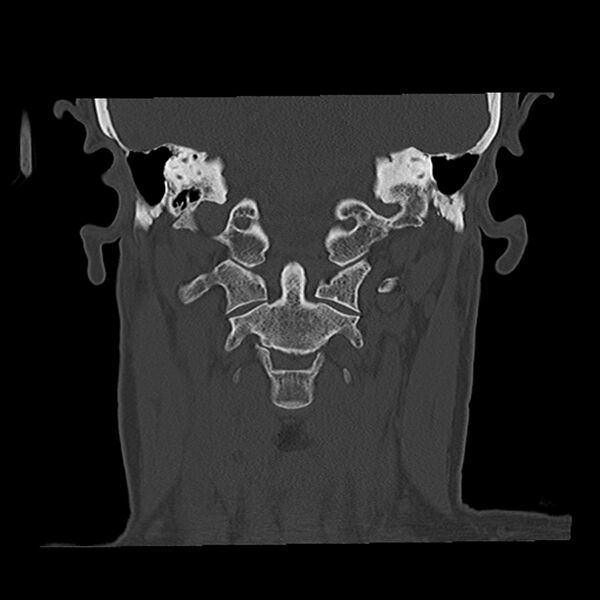 File:Canal up mastoidectomy (Radiopaedia 78108-90638 Coronal bone window 38).jpg