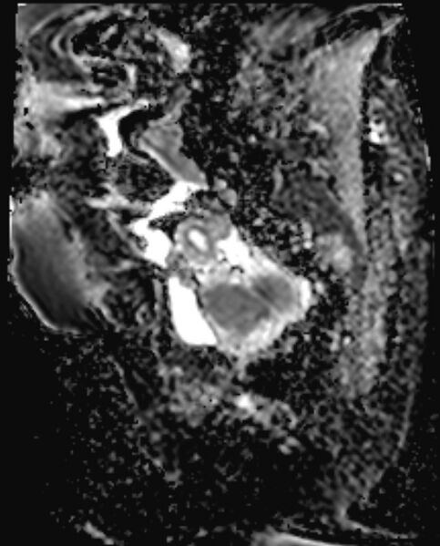 File:Cancer cervix - stage IIb (Radiopaedia 75411-86615 Sagittal ADC 7).jpg