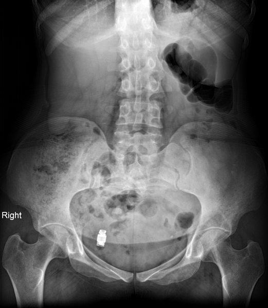 File:Capsule endoscopy on pelvic x-ray (Radiopaedia 85102).PNG