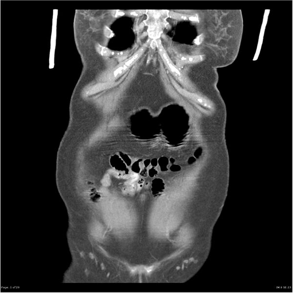 File:Carcinoid tumor of the ileum with metastasis to orbit (Radiopaedia 28165-28425 B 1).jpg