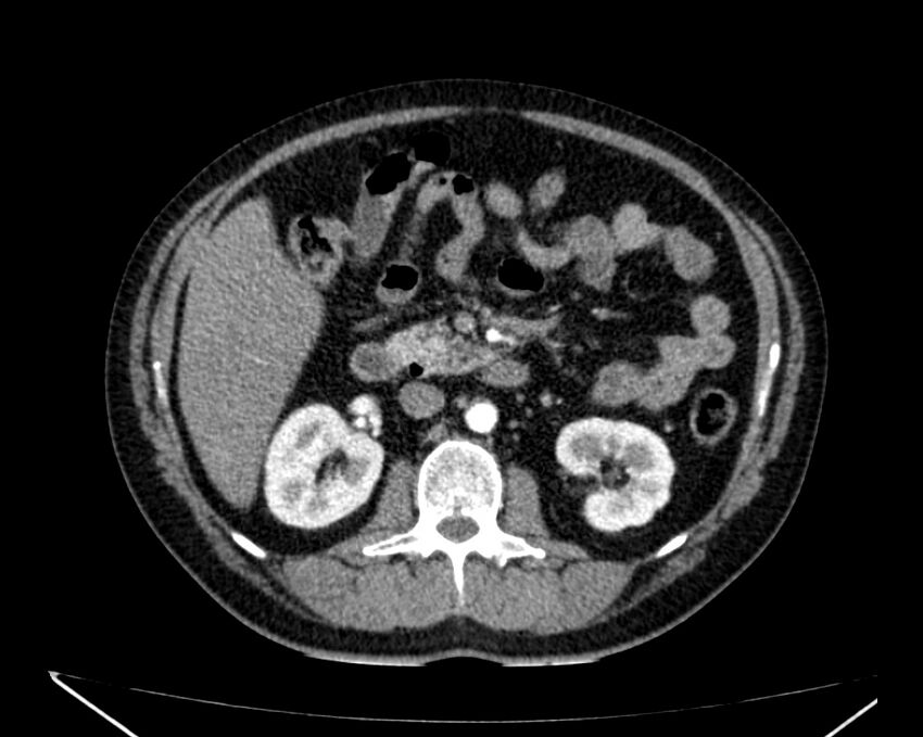 Carcinoid tumor with hepatic metastases (Radiopaedia 22651-22670 B 37).jpg