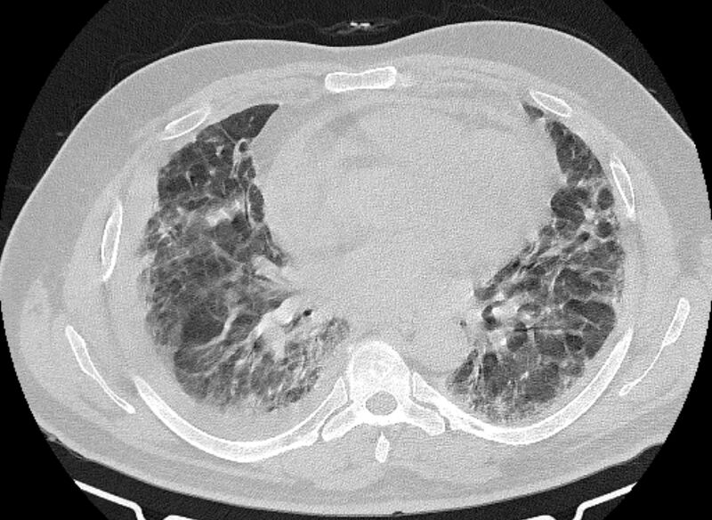 File:Cardiogenic pulmonary edema (Radiopaedia 68180-77678 Axial lung window 57).jpg