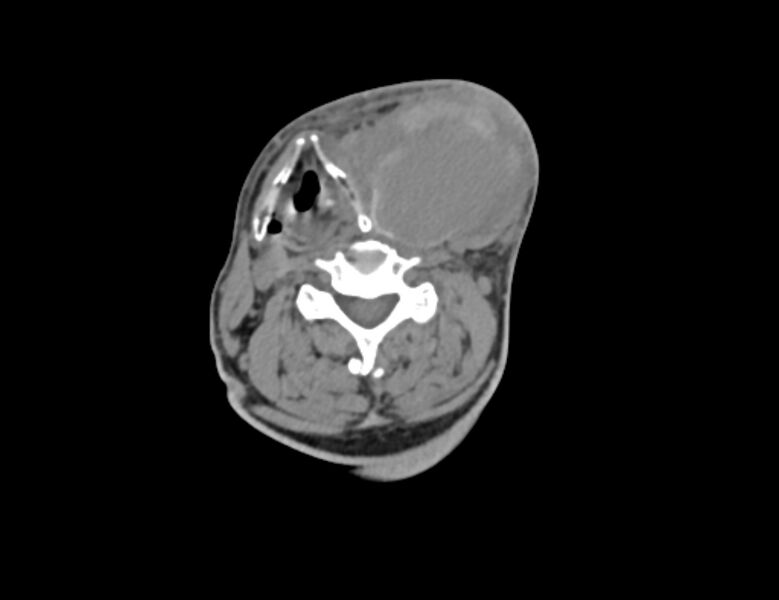 File:Carotid artery pseudoaneurysm (Radiopaedia 84030-99259 Axial non-contrast 29).jpg