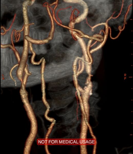 File:Carotid artery stenosis (Radiopaedia 28786-29086 A 7).jpg