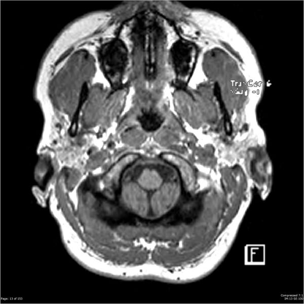 File:Cavernous malformation (cavernous angioma or cavernoma) (Radiopaedia 36675-38237 Axial T1 2).jpg
