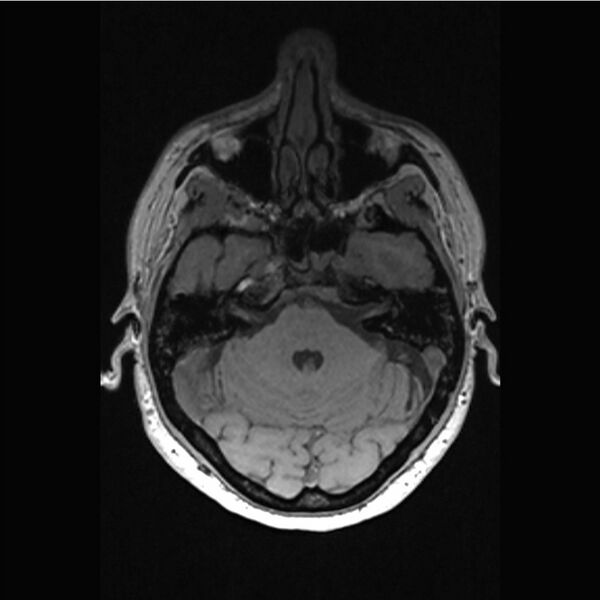 File:Central base of skull meningioma (Radiopaedia 53531-59549 Axial T1 5).jpg