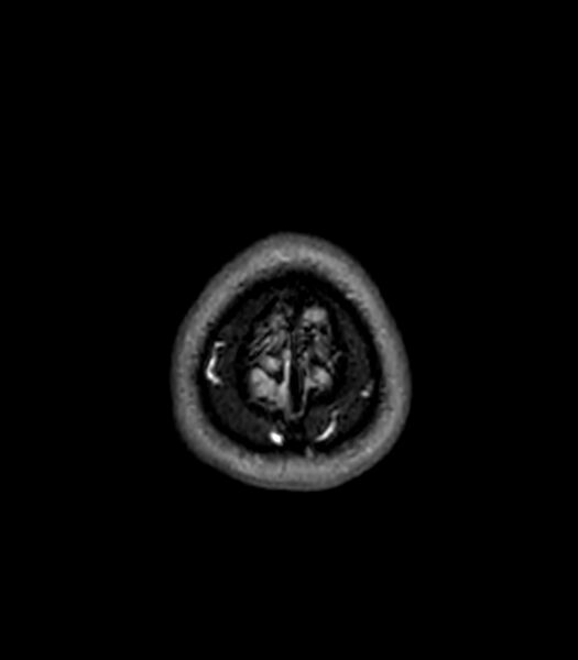 File:Central neurocytoma (Radiopaedia 79320-92380 Axial FLAIR 32).jpg