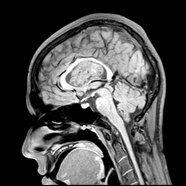 File:Central neurocytoma (Radiopaedia 79320-92380 Sagittal T1 129).jpg