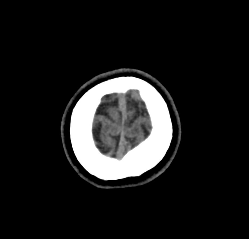 Cerebellar agenesis (Radiopaedia 30203-30817 Axial non-contrast 49).jpg
