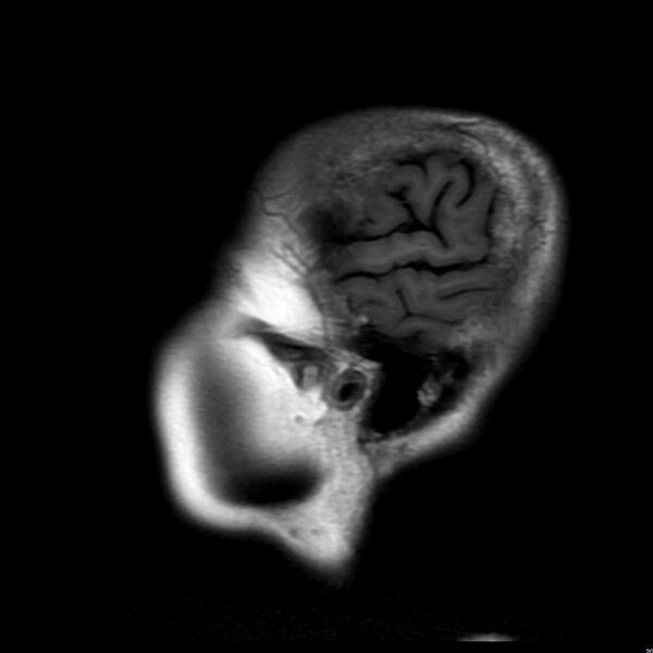 File:Cerebellar ataxia with neuropathy and vestibular areflexia syndrome (CANVAS) (Radiopaedia 74283-85159 Sagittal FLAIR 2).jpg