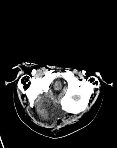 File:Cerebellar infarct due to vertebral artery dissection with posterior fossa decompression (Radiopaedia 82779-97033 Axial non-contrast 6).png