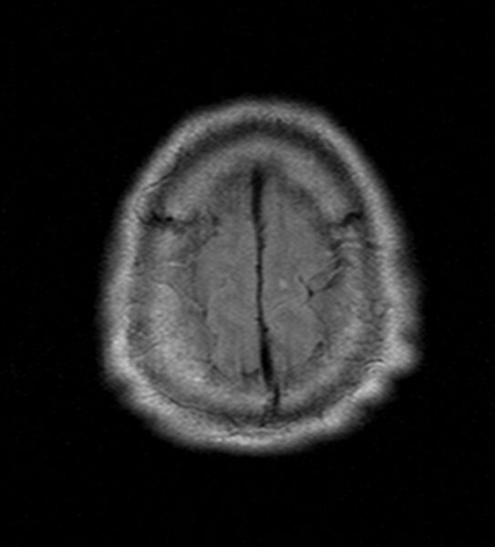 File:Cerebellopontine angle meningioma (Radiopaedia 24459-24764 Axial FLAIR 23).jpg