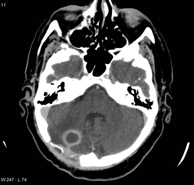 File:Cerebral abscess after posterior fossa craniectomy (Radiopaedia 5299).jpg