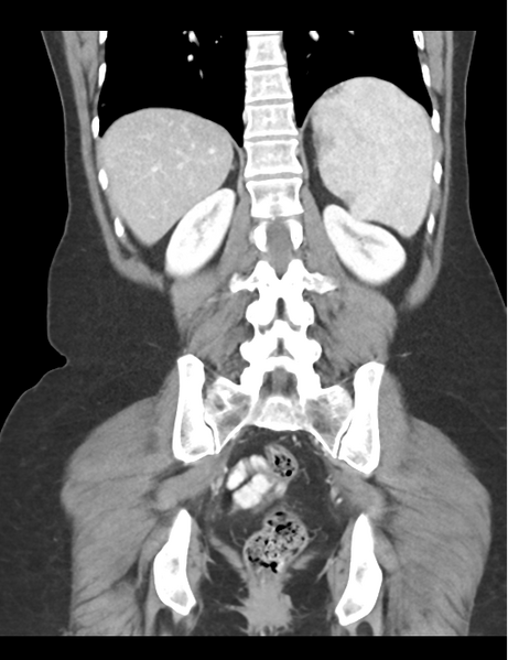File:Cerebral abscess from pulmonary arteriovenous malformation (Radiopaedia 86275-102292 D 38).png