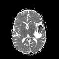 Cerebral abscess post cardiac surgery (Radiopaedia 27244-27420 Axial ADC 13).jpg