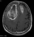 Cerebral abscesses secondary to contusions (Radiopaedia 5201-6968 Axial T1 C+ 1).jpg