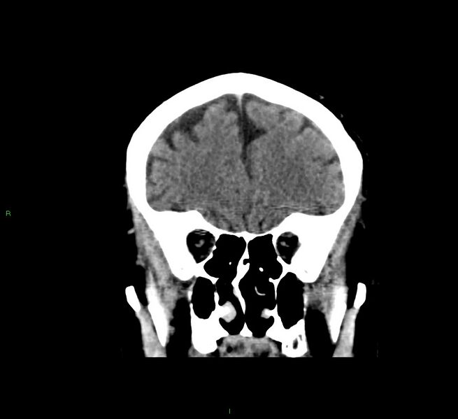 File:Cerebral amyloid angiopathy-associated lobar intracerebral hemorrhage (Radiopaedia 58376-65511 Coronal non-contrast 49).jpg