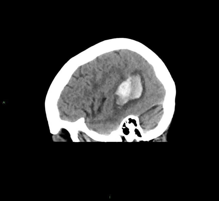 Cerebral amyloid angiopathy-associated lobar intracerebral hemorrhage (Radiopaedia 58378-65516 C 12).jpg
