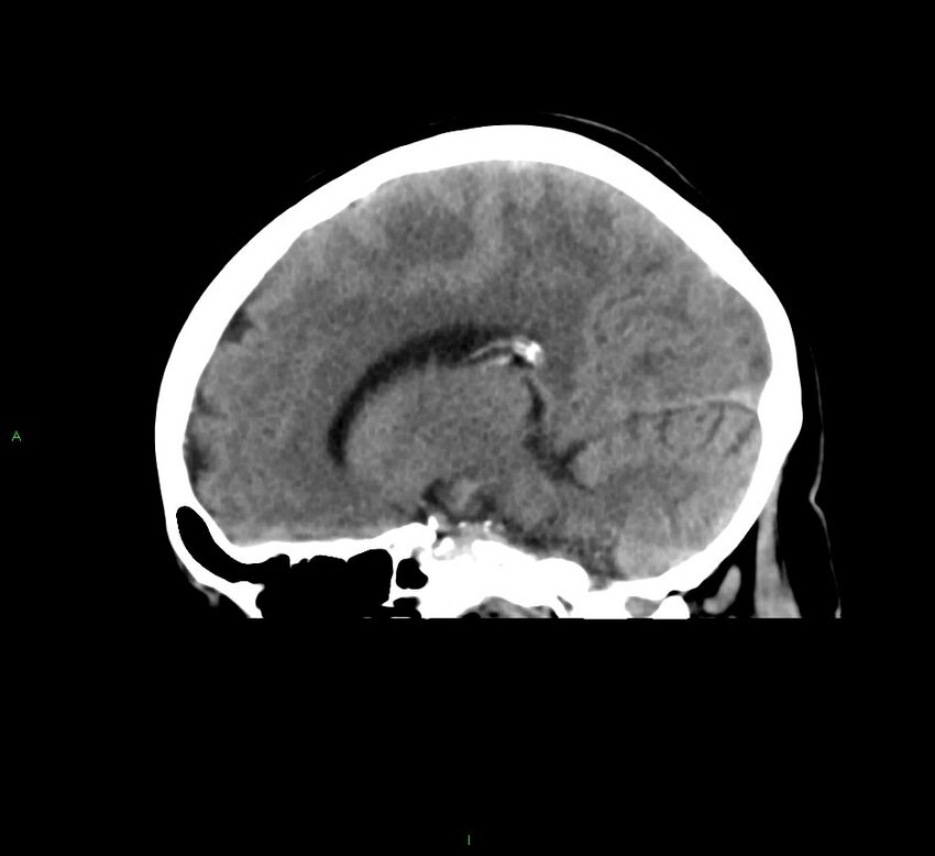 Cerebral amyloid angiopathy-associated lobar intracerebral hemorrhage (Radiopaedia 58378-65516 C 22).jpg