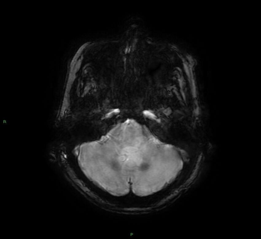 Cerebral amyloid angiopathy-associated lobar intracerebral hemorrhage (Radiopaedia 58378-65517 Axial SWI 16).jpg