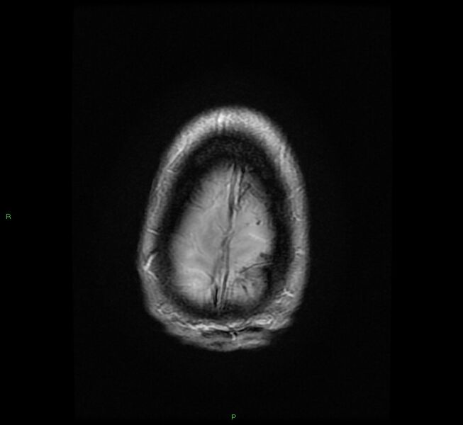 File:Cerebral amyloid angiopathy-associated lobar intracerebral hemorrhage (Radiopaedia 58529-65684 Axial Gradient Echo 24).jpg