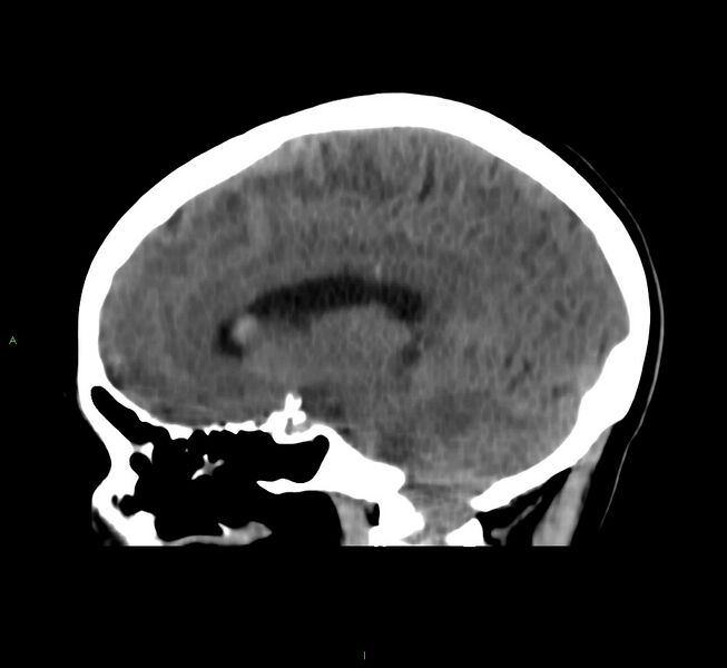File:Cerebral amyloid angiopathy-associated lobar intracerebral hemorrhage (Radiopaedia 58566-65730 C 29).jpg