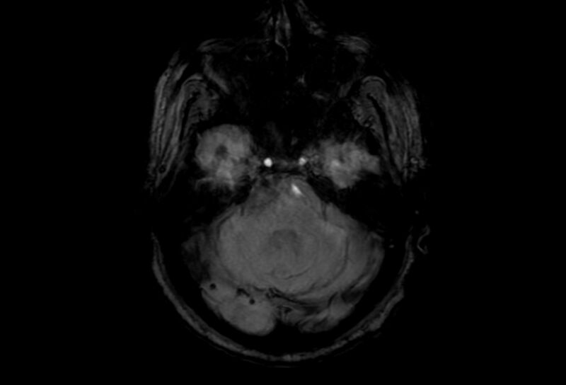 File:Cerebral amyloid angiopathy (Radiopaedia 86671-102792 Axial Gradient Echo 42).jpg