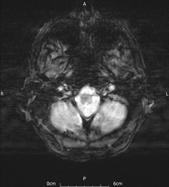 File:Cerebral amyloid angiopathy related inflammation (Radiopaedia 72772-83415 Axial SWI 4).jpg