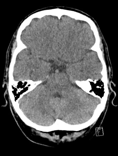 File:Cerebral arteriovenous malformation (Radiopaedia 78188-90745 Axial non-contrast 7).jpg