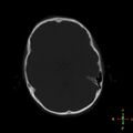 Cerebral contusion (Radiopaedia 48869-53911 Axial bone window 14).jpg