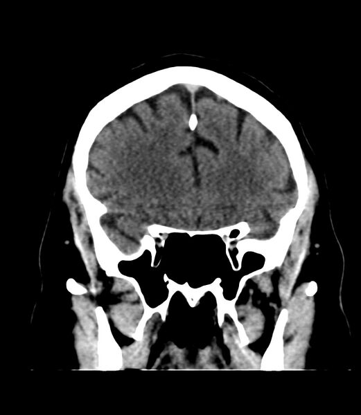 File:Cerebral dural venous sinus thrombosis (Radiopaedia 86514-102575 Coronal non-contrast 12).jpg