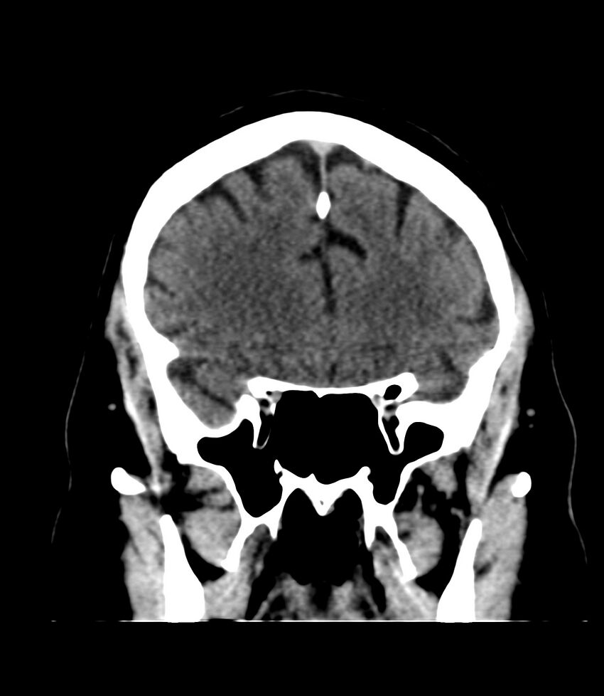 Cerebral dural venous sinus thrombosis (Radiopaedia 86514-102575 Coronal non-contrast 12).jpg