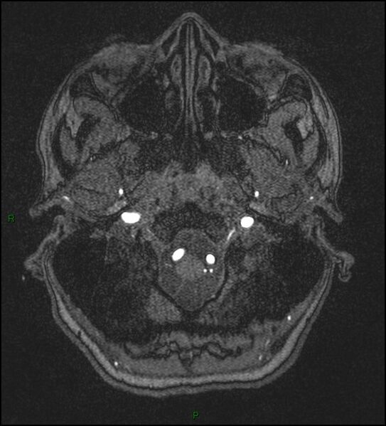 File:Cerebral fat embolism (Radiopaedia 35022-36525 Axial TOF 14).jpg