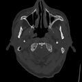 Cerebral hemorrhagic contusions (Radiopaedia 23145-23188 Axial bone window 2).jpg