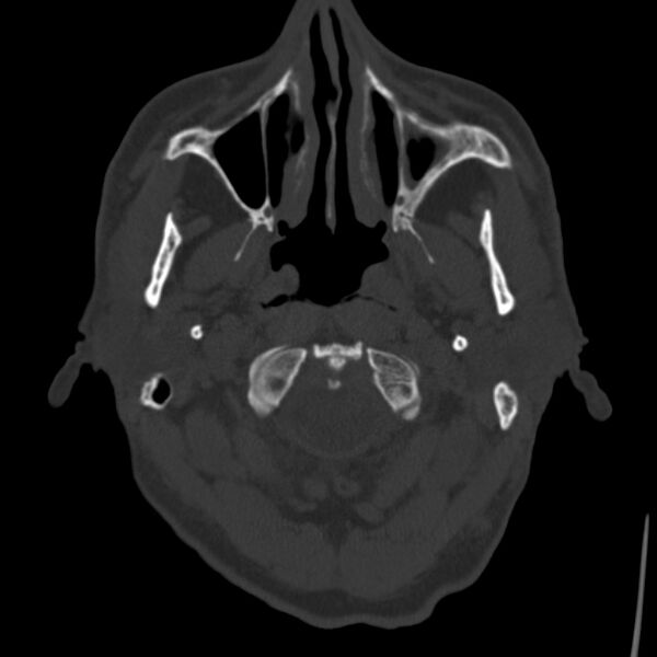 File:Cerebral hemorrhagic contusions (Radiopaedia 23145-23188 Axial bone window 2).jpg