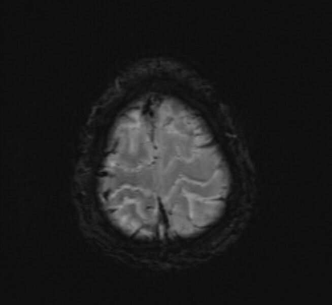 File:Cerebral venous thrombosis (Radiopaedia 71207-81504 Axial SWI 49).jpg