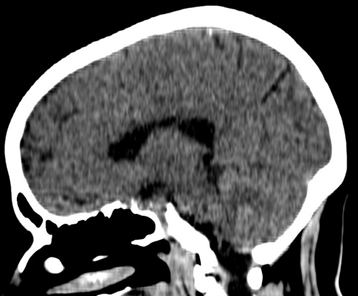 File:Cerebral venous thrombosis - CT only (Radiopaedia 41031-43778 B 13).jpg