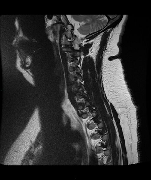 File:Cervical disc prolapse (Radiopaedia 80258-93598 Sagittal T2 12).jpg