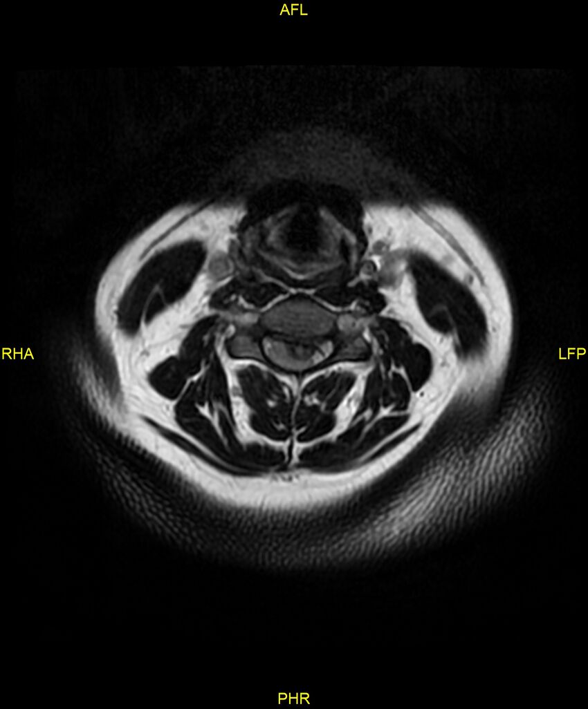 Cervical disc protrusion (Radiopaedia 87147-103415 Axial T2 13).jpg