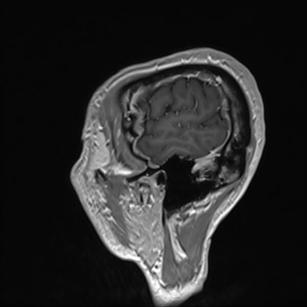 File:Cervical dural CSF leak on MRI and CT treated by blood patch (Radiopaedia 49748-54995 G 113).jpg
