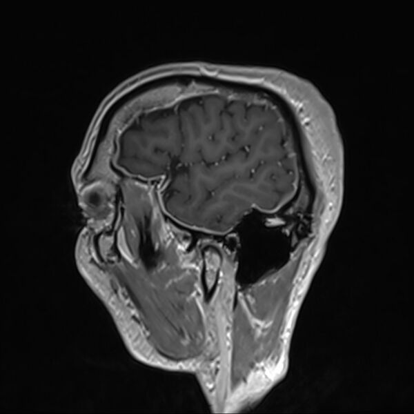 File:Cervical dural CSF leak on MRI and CT treated by blood patch (Radiopaedia 49748-54995 G 3).jpg