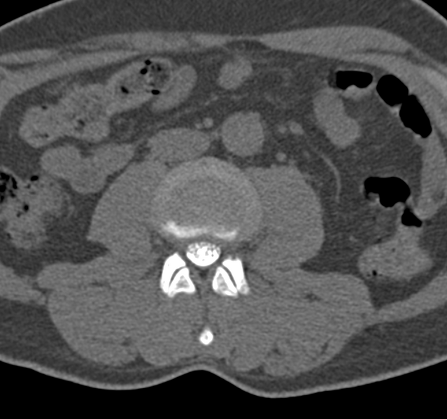 File:Cervical dural CSF leak on MRI and CT treated by blood patch (Radiopaedia 49748-54996 B 100).png