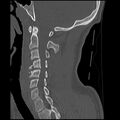 Cervical flexion teardrop fracture with cord hemorrhage (Radiopaedia 32497-33454 Sagittal bone window 19).jpg