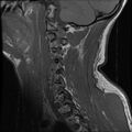 Cervical flexion teardrop fracture with cord hemorrhage (Radiopaedia 32497-33455 Sagittal T1 14).jpg