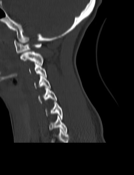 File:Cervical spine posterior ligamentous complex rupture (Radiopaedia 63486-72101 Sagittal bone window 19).jpg