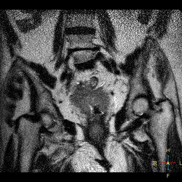 File:Cervical stump squamous cell carcinoma (Radiopaedia 48049-52858 Coronal T2 9).jpg