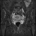 Cesarian section scar endometriosis (Radiopaedia 66520-75799 Coronal STIR 19).jpg