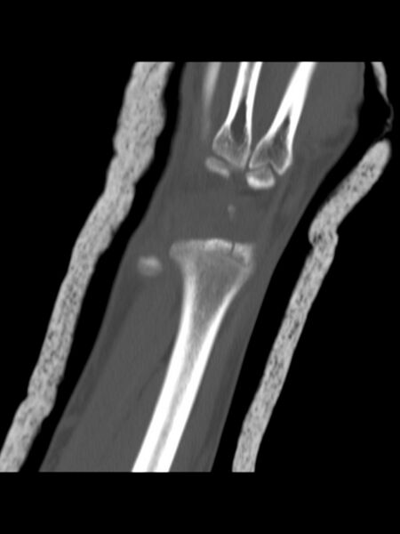 File:Chauffeur's (Hutchinson) fracture (Radiopaedia 58043-65079 Coronal bone window 11).jpg